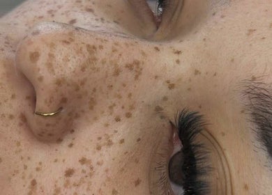Close-up of a serene face with freckles at 11:11 Beauty and Aesthetics, Highbridge, England, GB.