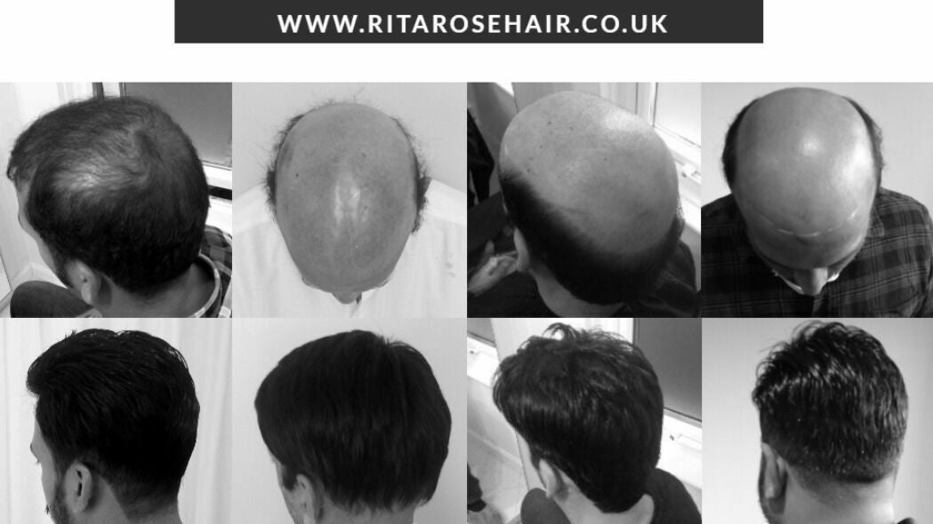 non surgical hair replacement uk