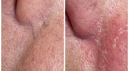 Before and after skin treatment at Confidence & Glow Aesthetics, Leeds, England, GB, showcasing glowing results.