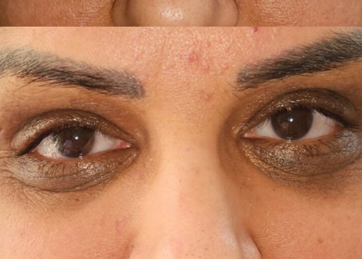 Close-up of eyes showcasing treatment results at Beauty Style Rbs Camouflage in Toronto, Ontario, CA.