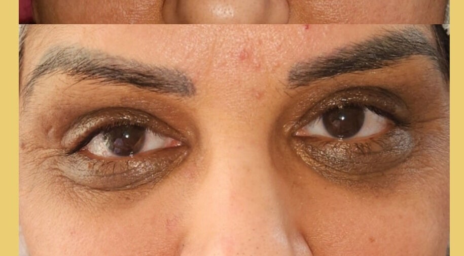 Close-up of eyes showcasing treatment results at Beauty Style Rbs Camouflage in Toronto, Ontario, CA.