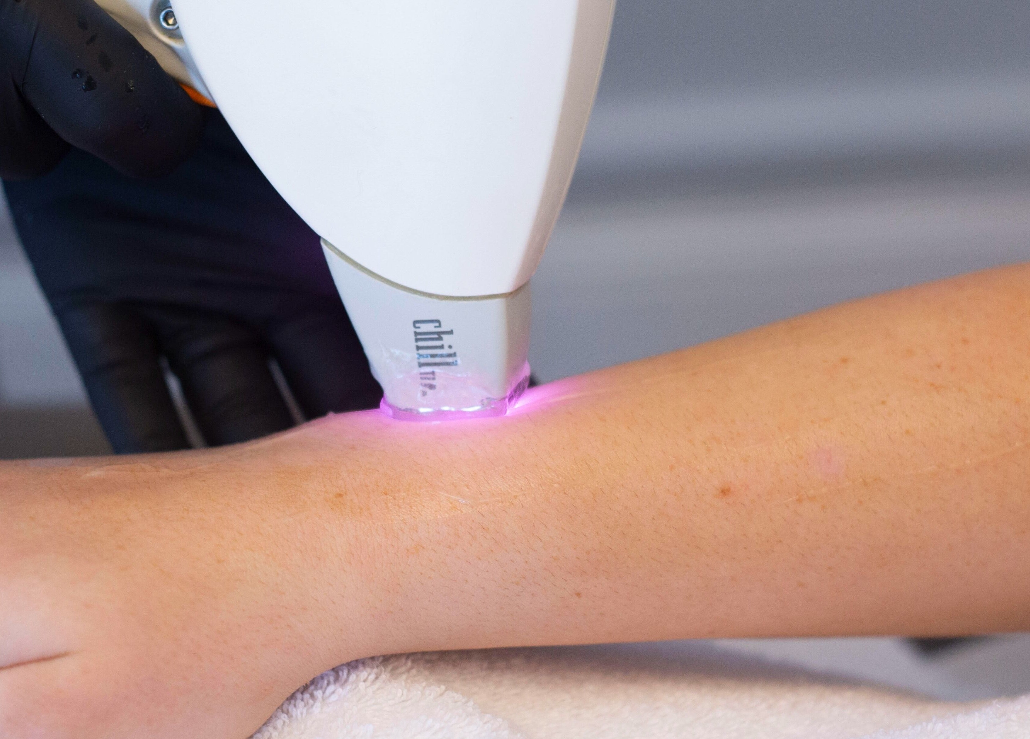 Laser hair removal at Bute House Aesthetics, Newmarket, England, GB, enhancing smooth arm skin.