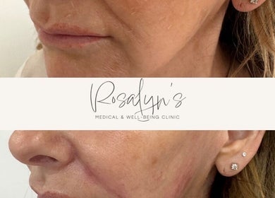 Before and after facial treatment at Rosalyn’s Medical Clinic, Wakefield, England, GB.