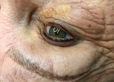 Close-up eye treatment at Beautiful New U, Boksburg, Gauteng, ZA