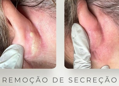 Tratamento de remoção de secreção na orelha em Daisy Wilson Aesthetic & Beauty S.U Lda, Matola, Maputo, MZ.