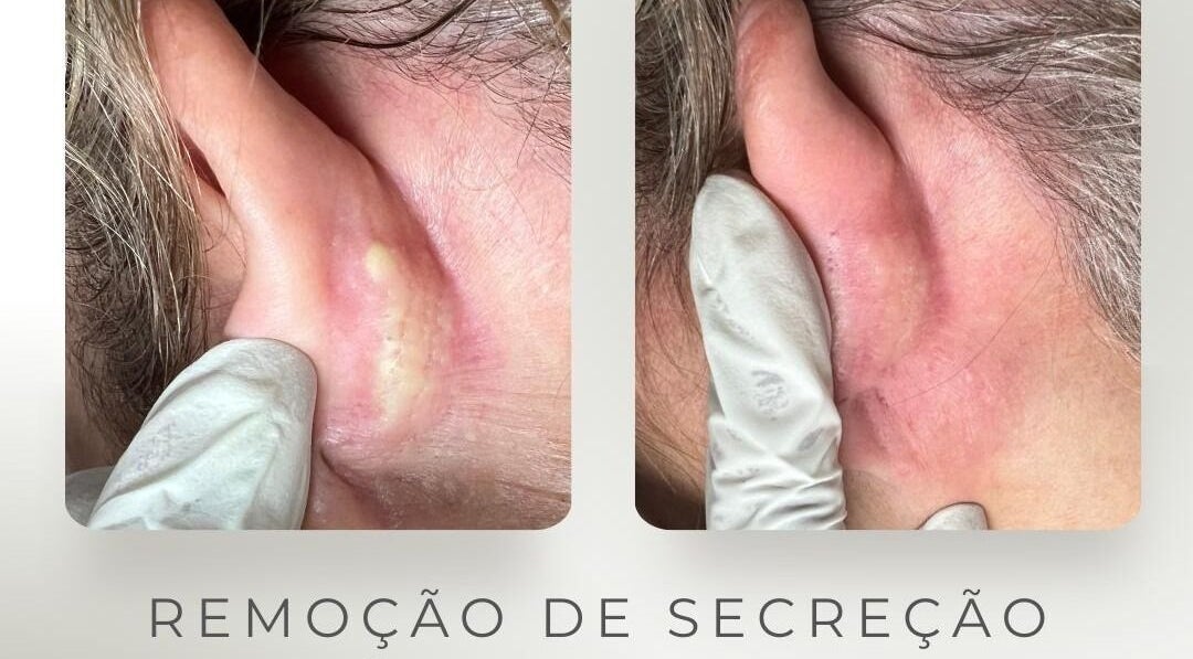 Tratamento de remoção de secreção na orelha em Daisy Wilson Aesthetic & Beauty S.U Lda, Matola, Maputo, MZ.