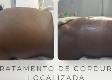 Antes e depois de tratamento de gordura localizada em Daisy Wilson Aesthetic & Beauty S.U Lda, Matola, Maputo, MZ.