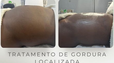Antes e depois de tratamento de gordura localizada em Daisy Wilson Aesthetic & Beauty S.U Lda, Matola, Maputo, MZ.