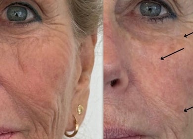 Before and after wrinkle treatment at Salt Beauty Ballina, Ballina, New South Wales, AU showing smoother skin.