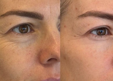 Before and after eye treatment at Salt Beauty Ballina, Ballina, New South Wales, AU.