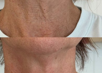 Before and after neck treatment at Salt Beauty Ballina, Ballina, New South Wales, AU.