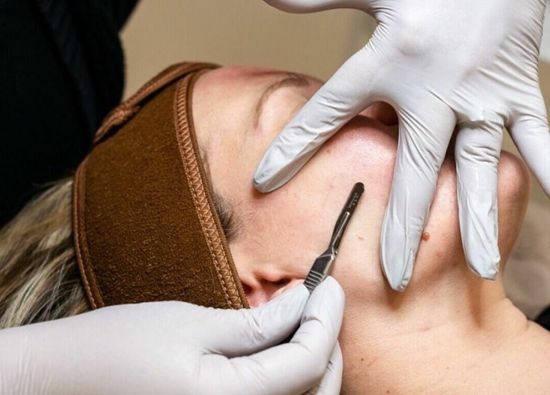 Dermaplaning treatment at Remedy Salon, Appleton, Wisconsin, US for smooth, radiant skin.