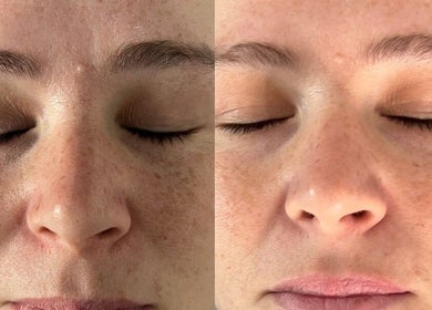 Before and after facial treatment at Aesthetic Skin Lab Ireland, Dublin 15, IE with visible skin improvement.