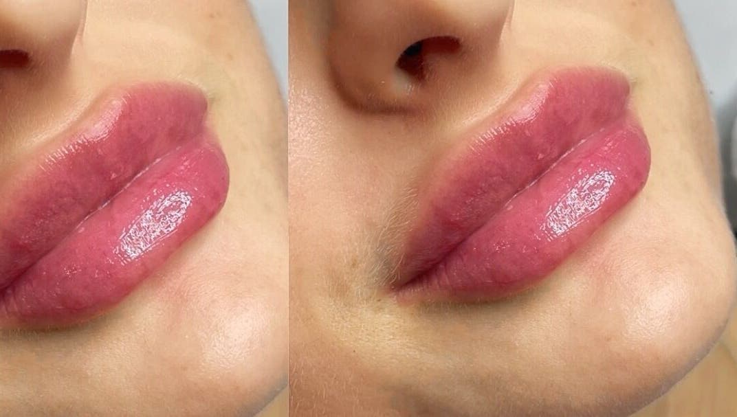 Lip enhancement at Dazzling Beauty & Aesthetics, Whitehead, Northern Ireland, GB.