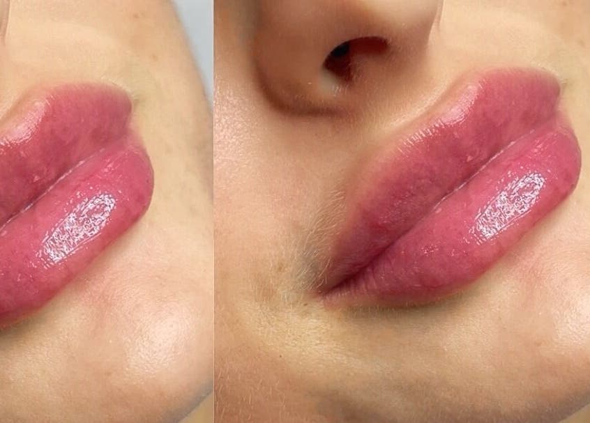 Lip enhancement at Dazzling Beauty & Aesthetics, Whitehead, Northern Ireland, GB.