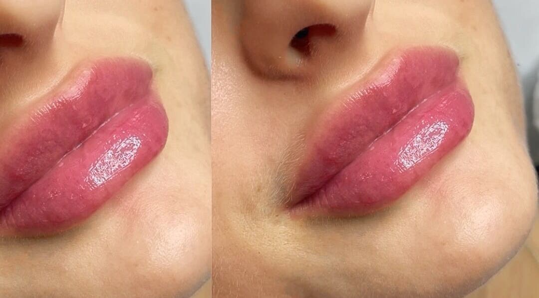 Lip enhancement at Dazzling Beauty & Aesthetics, Whitehead, Northern Ireland, GB.