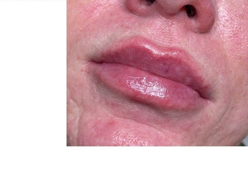 Lip enhancement at Dazzling Beauty & Aesthetics, Whitehead, Northern Ireland, GB. Smooth, rejuvenated appearance.