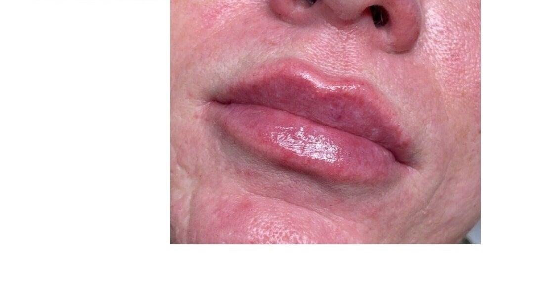 Lip enhancement at Dazzling Beauty & Aesthetics, Whitehead, Northern Ireland, GB. Smooth, rejuvenated appearance.
