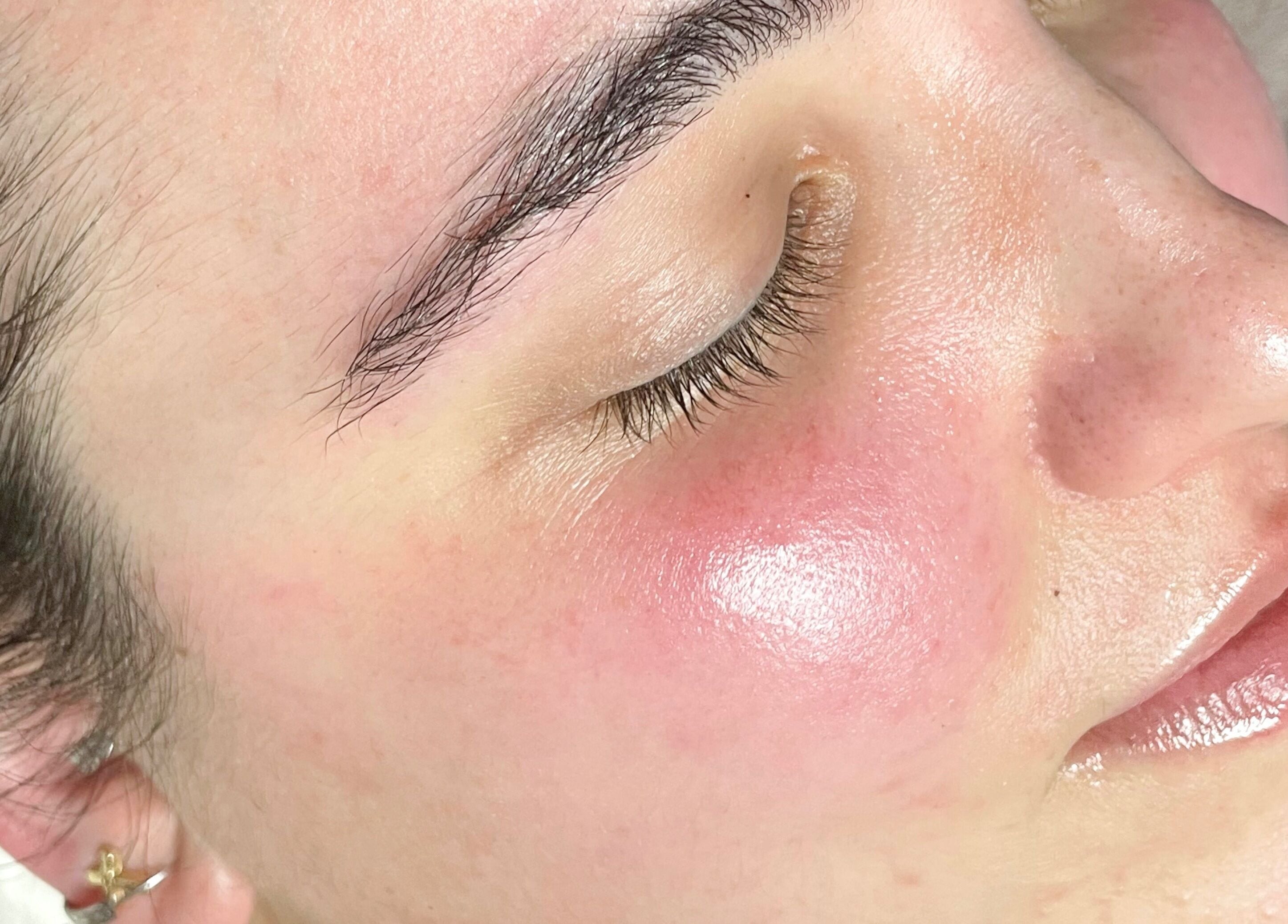 Face after treatment at Little Rest Skin Treatment Room in Birmingham, England, GB, showcasing smooth, glowing skin.