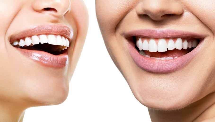 Illuminate Teeth Whitening image 1