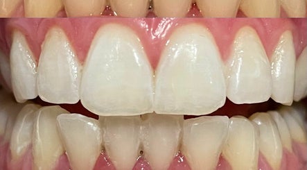 Illuminate Teeth Whitening image 3