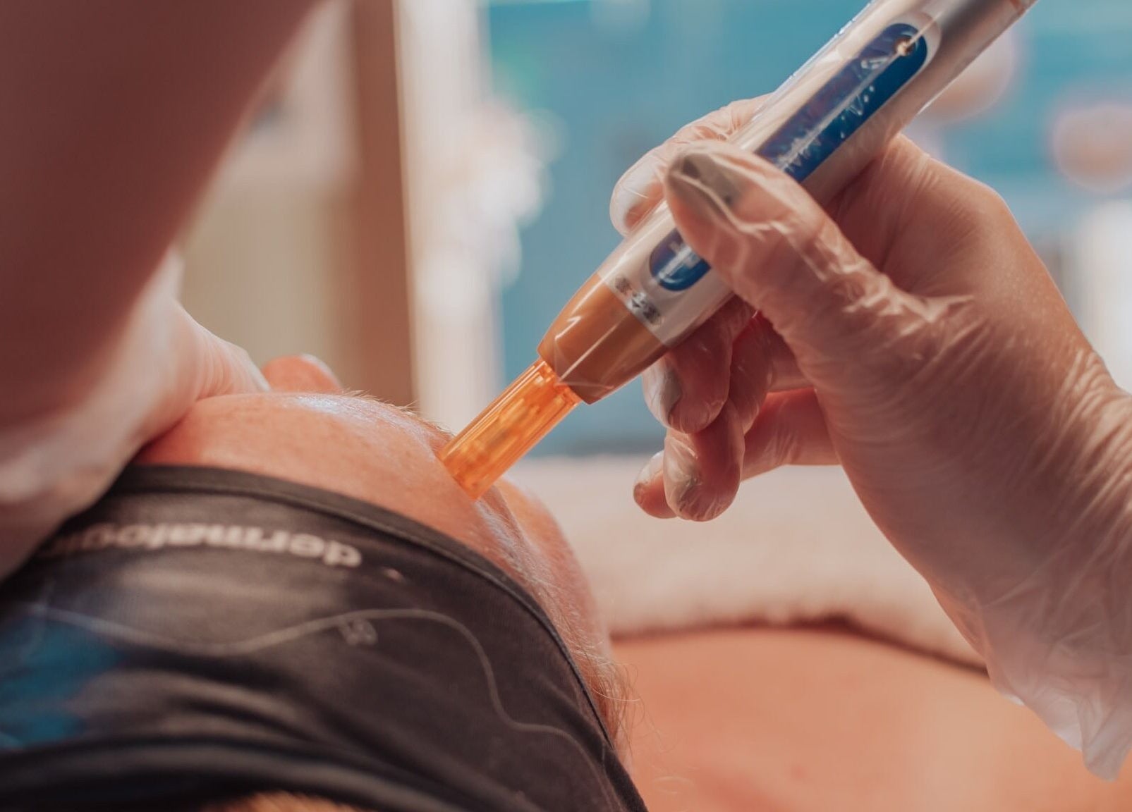 Professional dermal treatment at Bare All Skin, Redruth, England, GB, enhancing skin wellness.