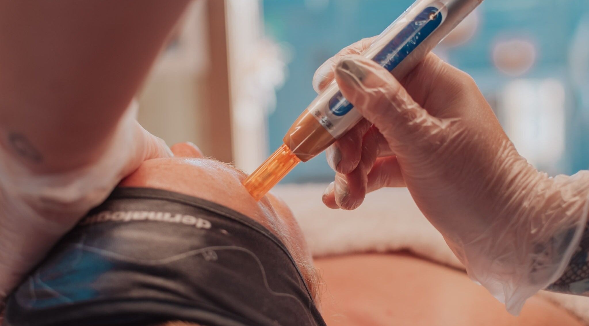 Professional dermal treatment at Bare All Skin, Redruth, England, GB, enhancing skin wellness.