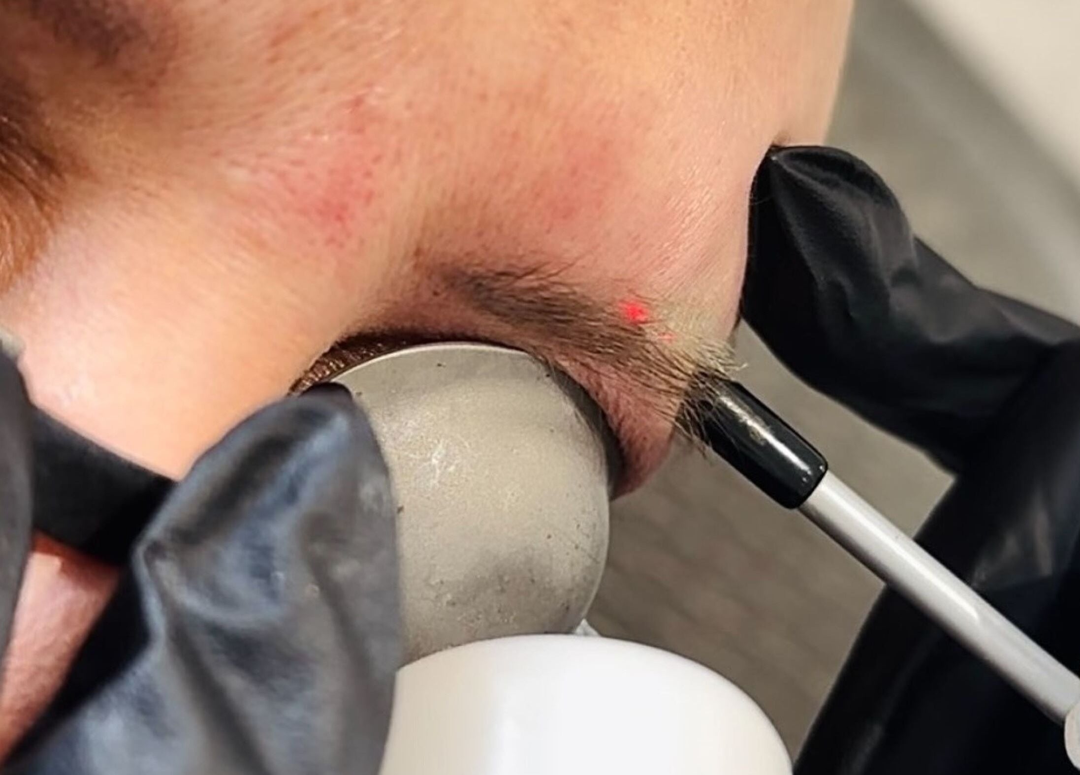 Close-up of eyebrow laser treatment at Harley Skin and Laser in Stoke-on-Trent, England, GB.