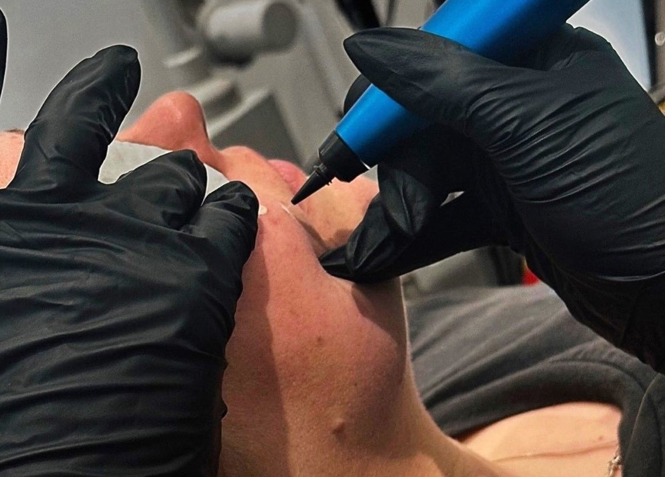 Close-up of cosmetic procedure at Harley Skin and Laser, Stoke-on-Trent, England, GB.