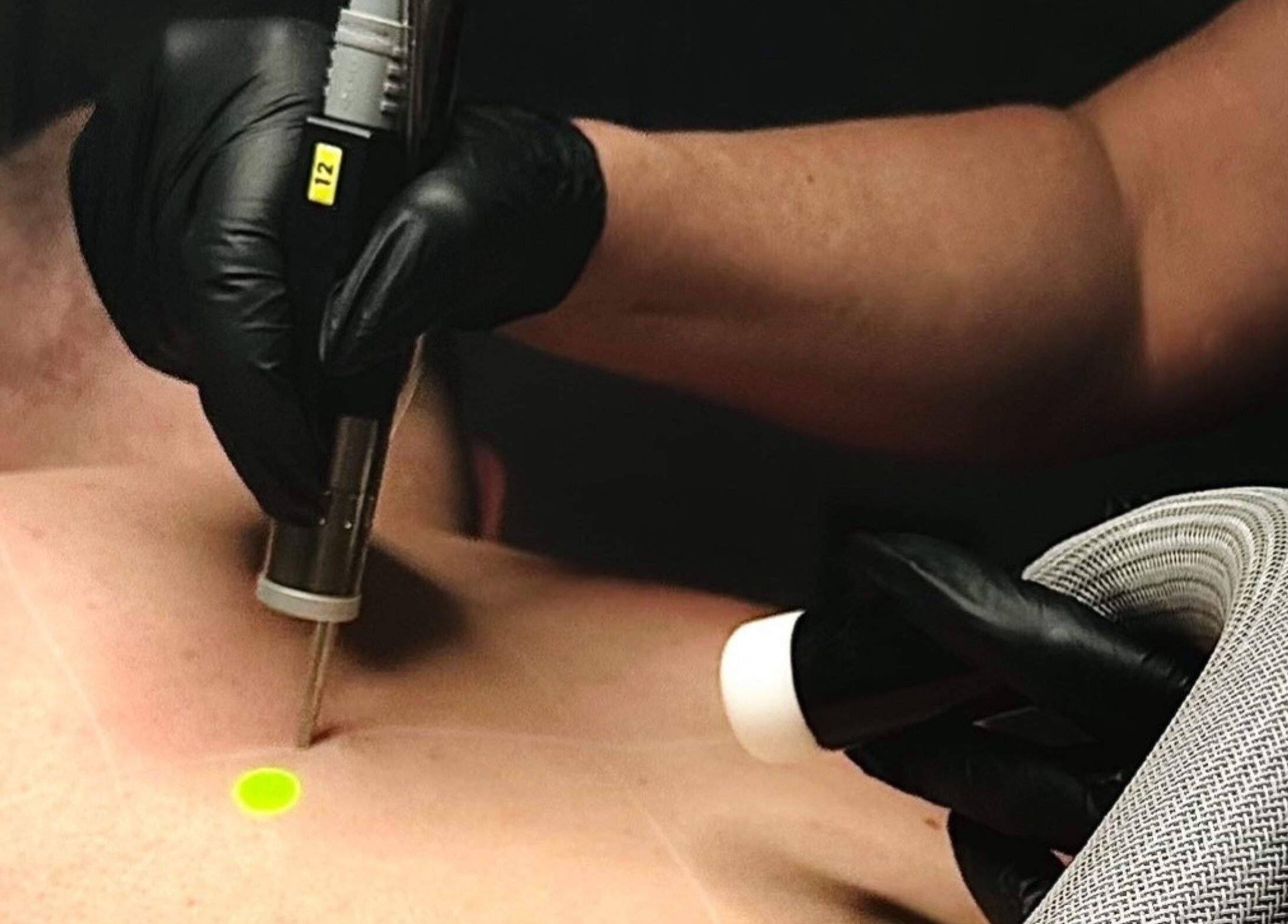 Laser treatment at Harley Skin and Laser in Stoke-on-Trent, England. Professional care shown in action.