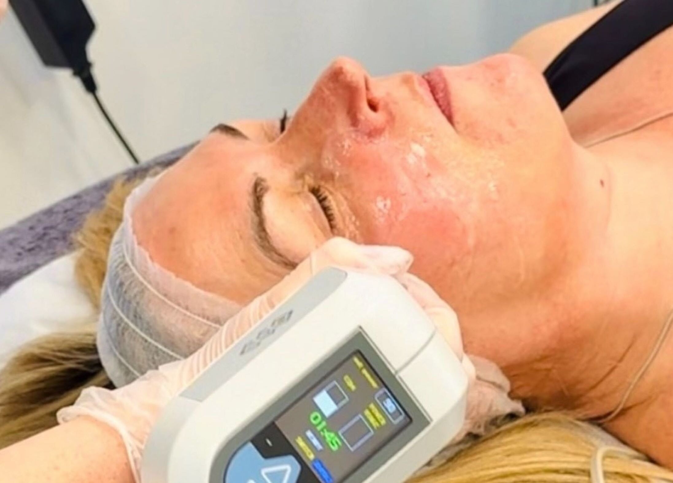 Facial laser treatment at Harley Skin and Laser in Stoke-on-Trent, England, GB, enhancing skin radiance.