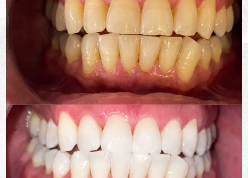 Teeth whitening result at Blanc Salon | Teeth Whitening & Korean Lash Lifts, Surfers Paradise, Queensland, AU.