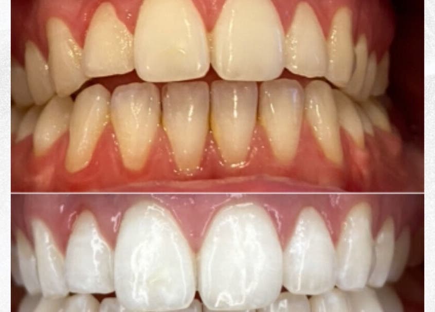 Blanc Salon | Teeth Whitening results in Surfers Paradise, Queensland, AU showcasing brighter, whiter teeth.