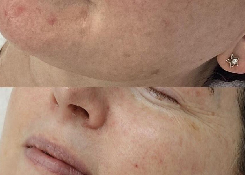 Before and after facial treatment at The Skin Edit - Quinns Rocks, Western Australia, AU showing visible skin improvement.
