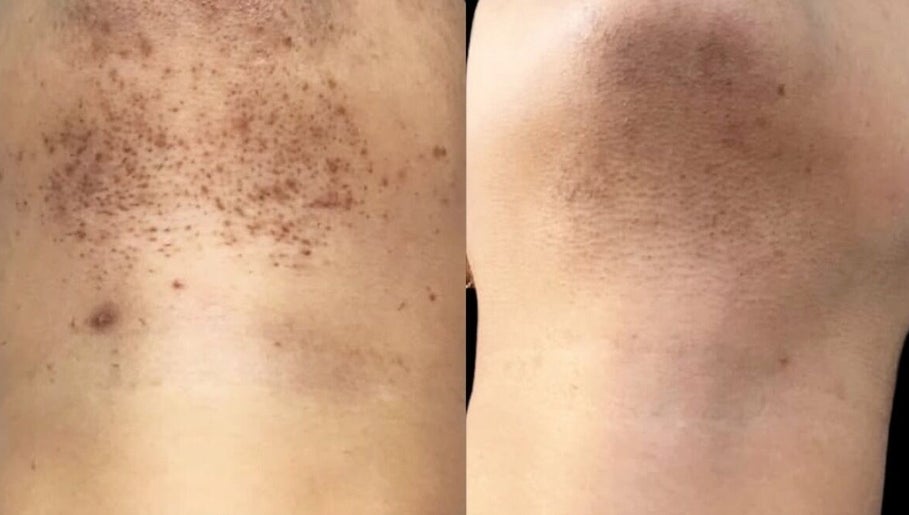 Before and after skin treatment at Beauty Empire Aesthetics, Tampa, Florida, US demonstrating remarkable results.