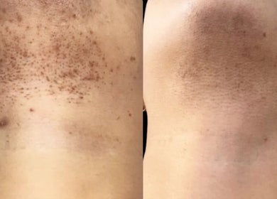 Before and after skin treatment at Beauty Empire Aesthetics, Tampa, Florida, US demonstrating remarkable results.