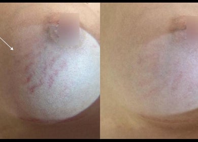 Before and after stretch mark treatment at Beauty Empire Aesthetics, Tampa, Florida, US.
