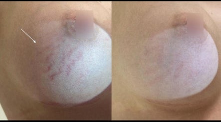 Before and after stretch mark treatment at Beauty Empire Aesthetics, Tampa, Florida, US.