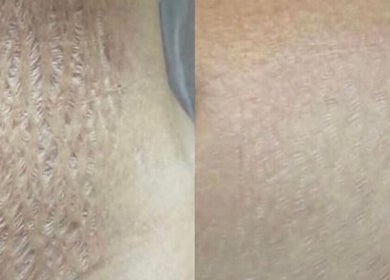 Before and after skin results at Beauty Empire Aesthetics in Tampa, Florida, US.