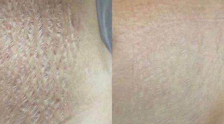 Before and after skin results at Beauty Empire Aesthetics in Tampa, Florida, US.