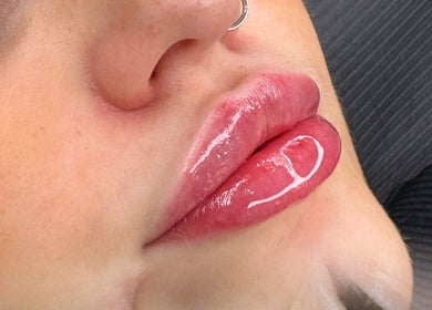 Glossy lip enhancement at The Beauty Factory, Ramsgate, England, GB showcasing perfect finish.
