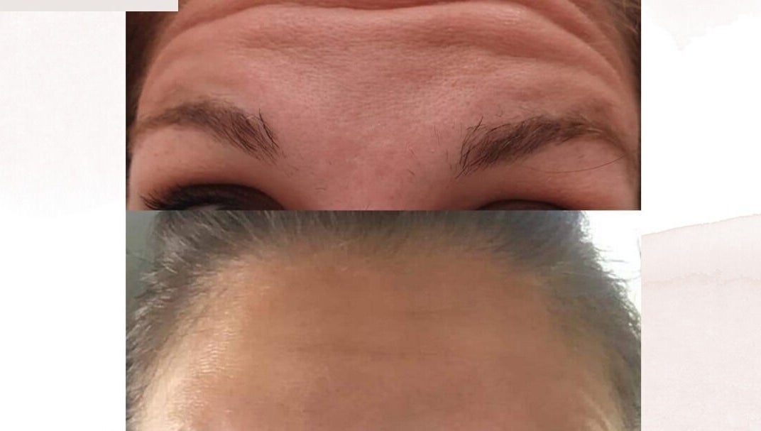 Before and after forehead treatment at D's Aesthetics, Redruth, England, GB, showcasing wrinkle reduction.