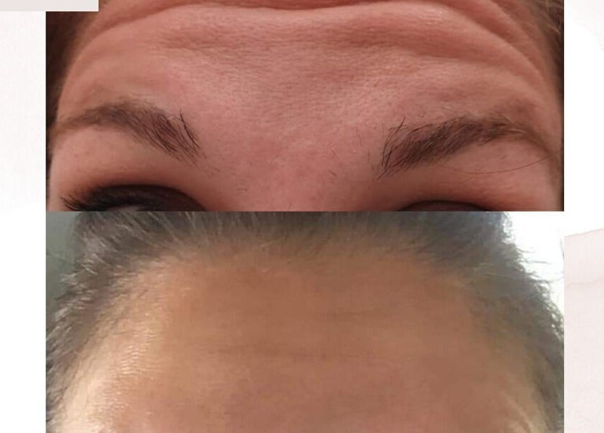 Before and after forehead treatment at D's Aesthetics, Redruth, England, GB, showcasing wrinkle reduction.