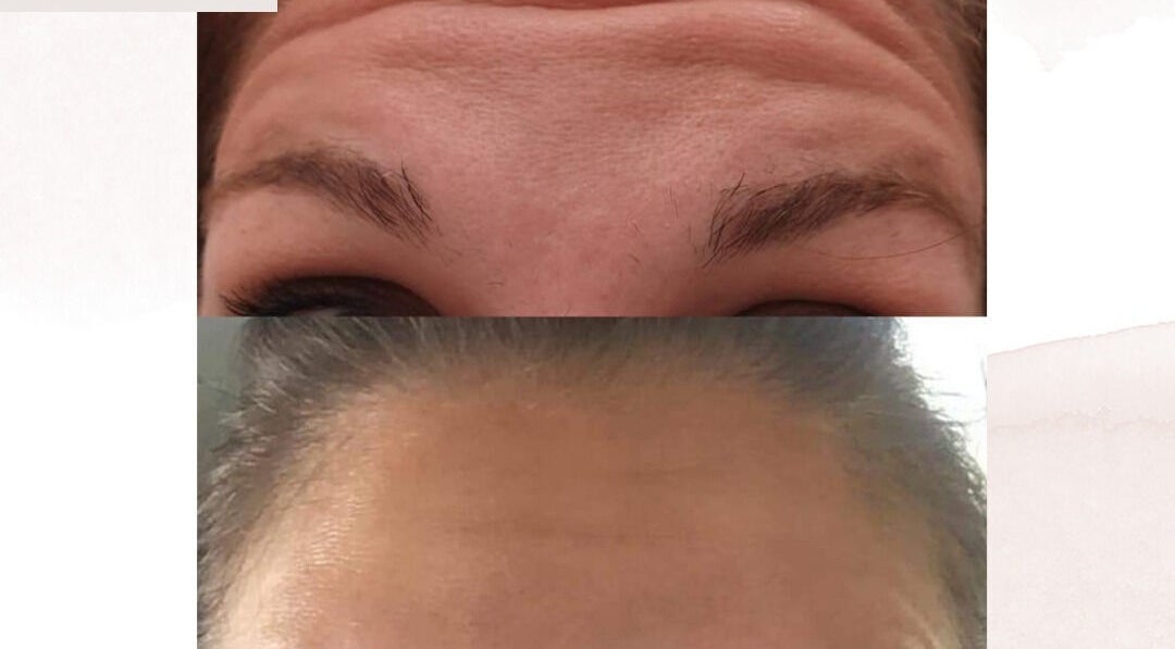 Before and after forehead treatment at D's Aesthetics, Redruth, England, GB, showcasing wrinkle reduction.
