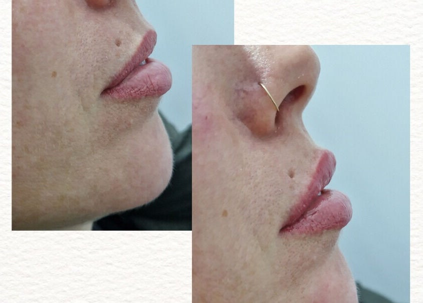 Lip enhancement treatment at D's Aesthetics in Redruth, England, GB showcasing natural results.