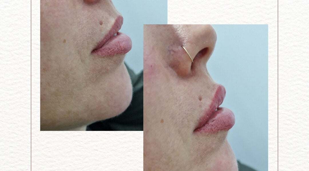 Lip enhancement treatment at D's Aesthetics in Redruth, England, GB showcasing natural results.
