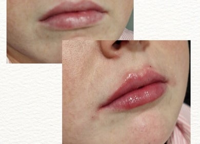 Lip enhancement at D's Aesthetics, Redruth, England, GB, showcasing subtle natural results.