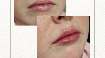 Lip enhancement at D's Aesthetics, Redruth, England, GB, showcasing subtle natural results.