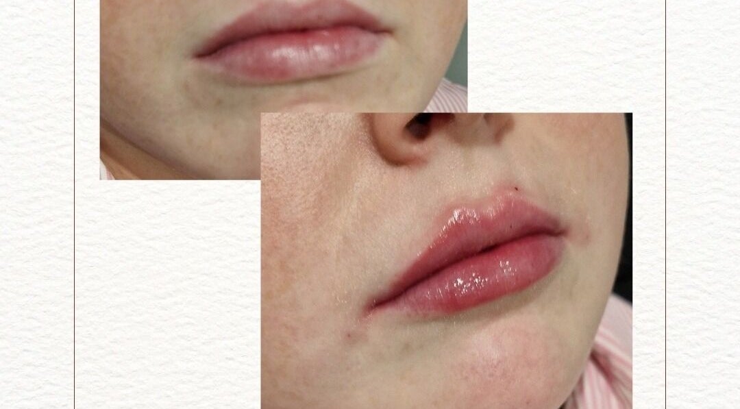Lip enhancement at D's Aesthetics, Redruth, England, GB, showcasing subtle natural results.