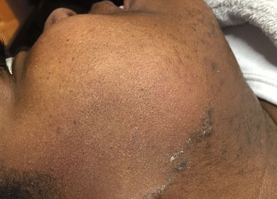 Soin visage à l'Institut L’impérial, Montréal, Québec, CA, peau apaisée sous serviette moelleuse.